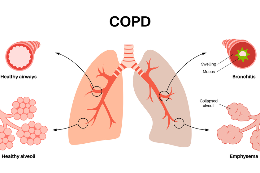 A Guide To COPD Care Management In A Memory Care Home In North Port, FL ...